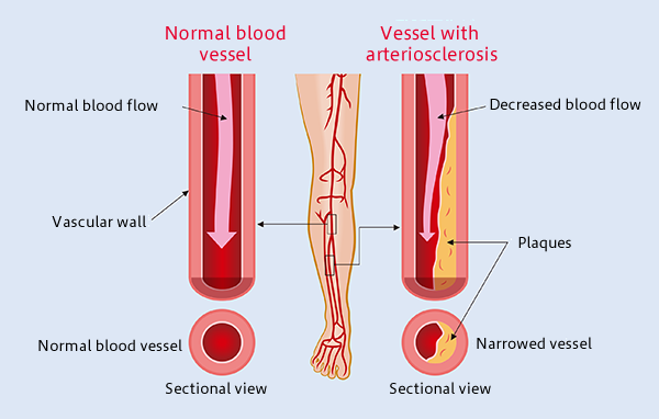 Atherosclerosis obliterans grade IV