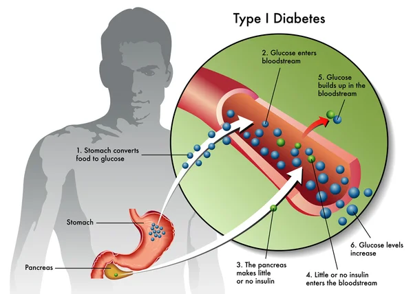 Stem cell treatment could offer one-end-solution to Diabetes